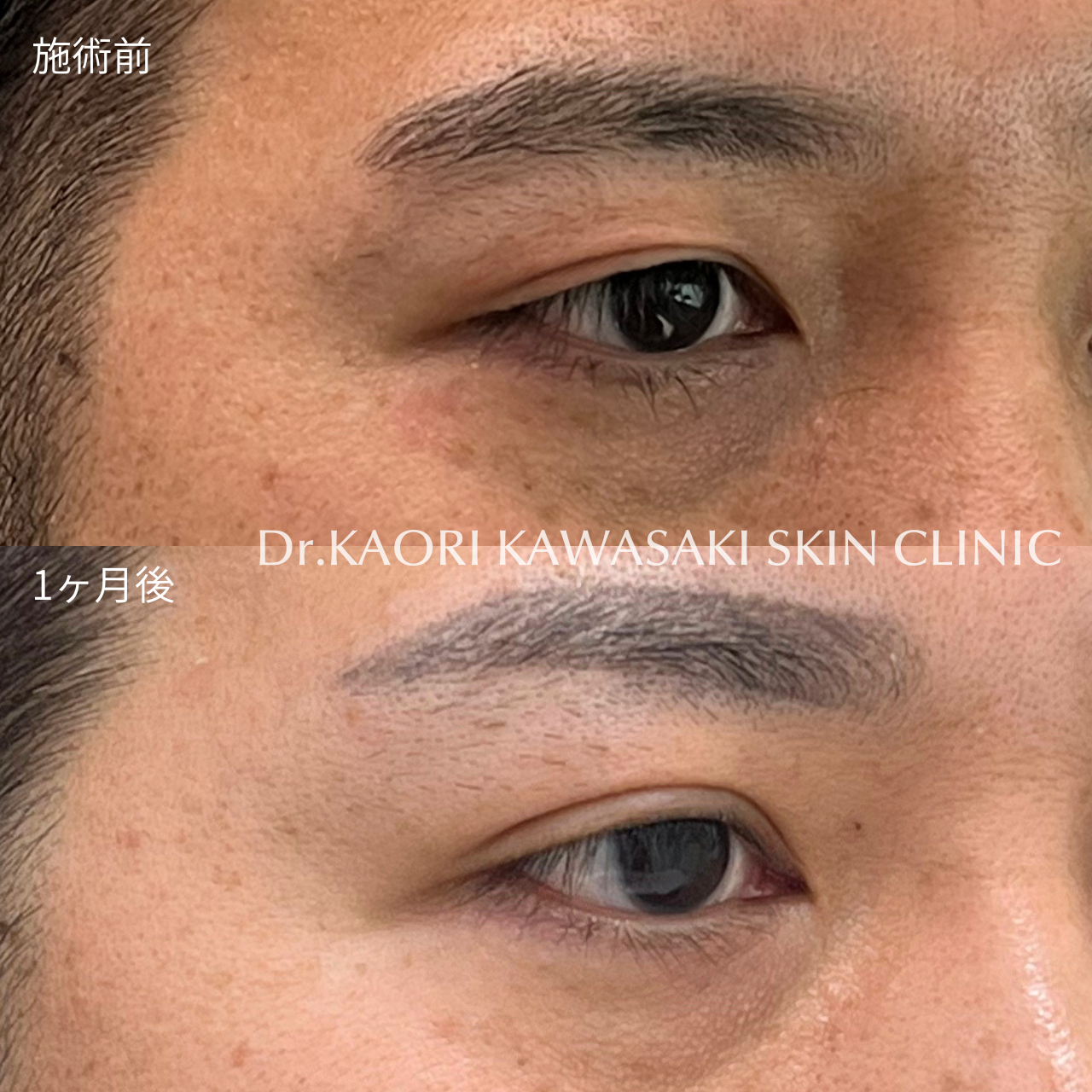 30代男性：右のみ眼瞼下垂(保険適用)
