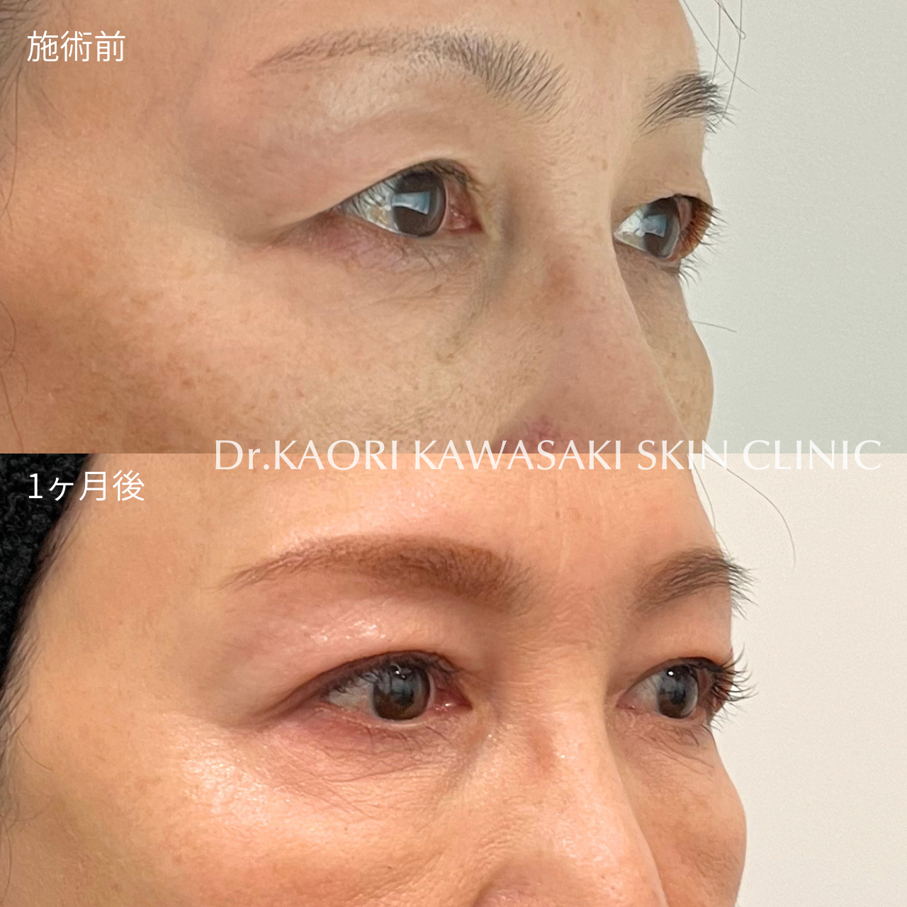 50代女性：眼瞼下垂手術（治療名：二重埋没直視下挙筋法）
